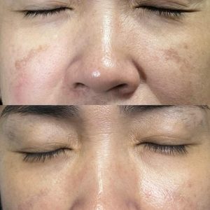 Elaine Ee before after